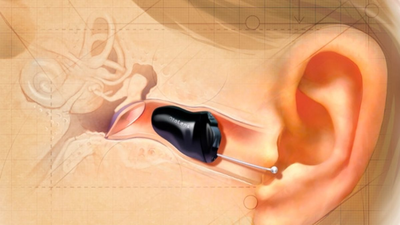 Invisible in the canal (IIC)