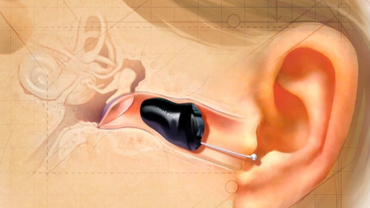 Invisible in the canal (IIC)